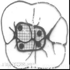 浅析根管口的探查(胡华)