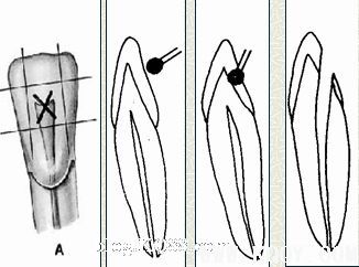 浅析根管口的探查(胡华)