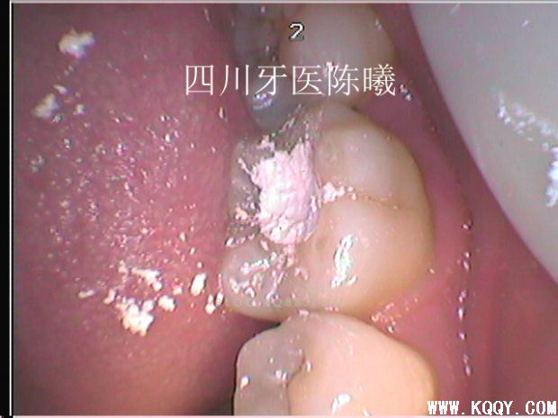 标准决定技术”--一例失败根充有感！--陈希