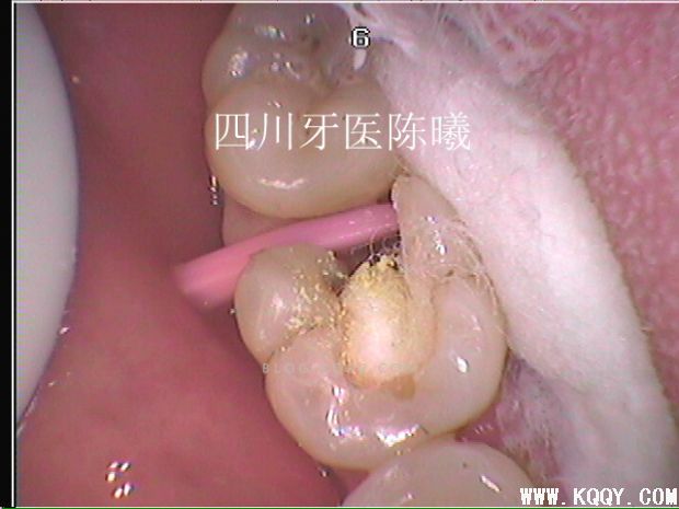 标准决定技术”--一例失败根充有感！--陈希