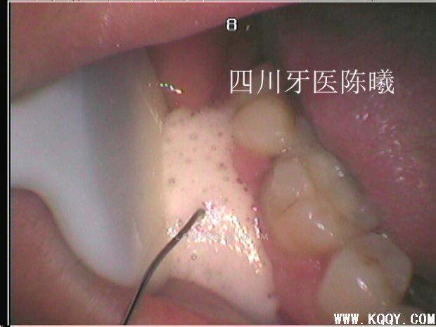 标准决定技术”--一例失败根充有感！--陈希
