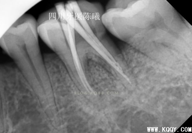 标准决定技术”--一例失败根充有感！--陈希