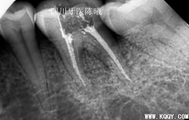 标准决定技术”--一例失败根充有感！--陈希