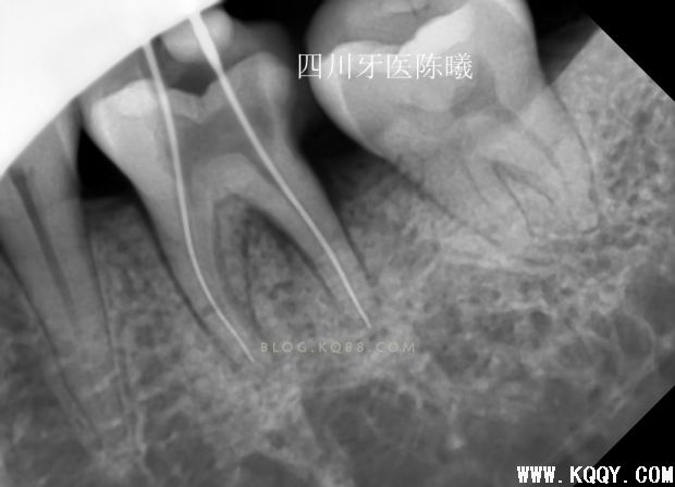 标准决定技术”--一例失败根充有感！--陈希