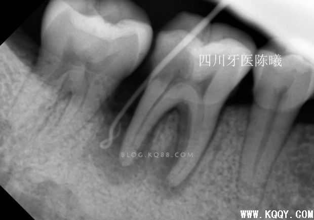 标准决定技术”--一例失败根充有感！--陈希