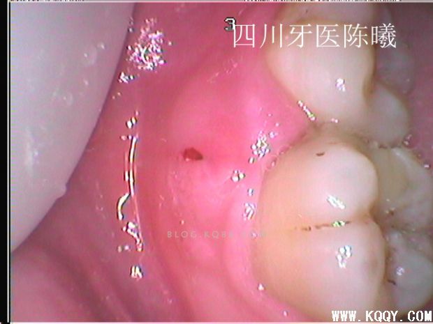 标准决定技术”--一例失败根充有感！--陈希