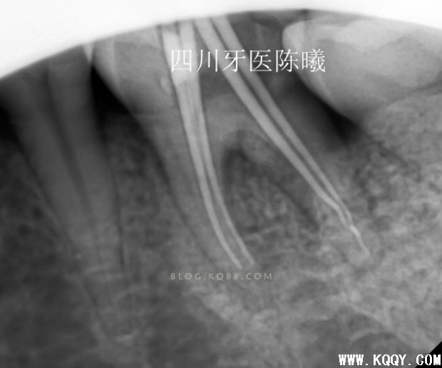 标准决定技术”--一例失败根充有感！--陈希