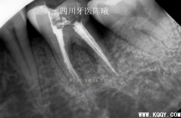标准决定技术”--一例失败根充有感！--陈希