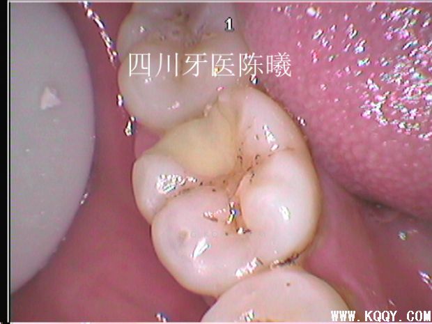 标准决定技术”--一例失败根充有感！--陈希