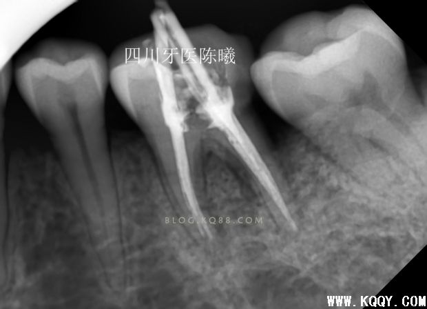 标准决定技术”--一例失败根充有感！--陈希