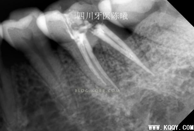 标准决定技术”--一例失败根充有感！--陈希