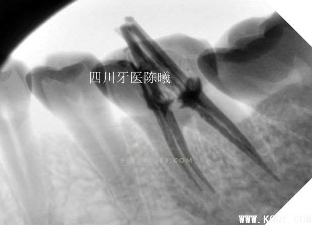 标准决定技术”--一例失败根充有感！--陈希