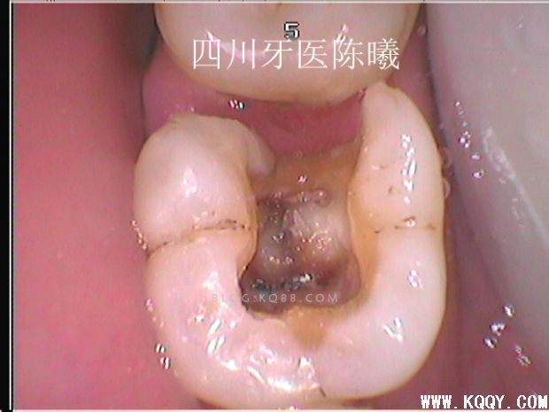 标准决定技术”--一例失败根充有感！--陈希