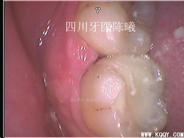 标准决定技术”--一例失败根充有感！--陈希
