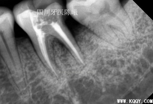 标准决定技术”--一例失败根充有感！--陈希