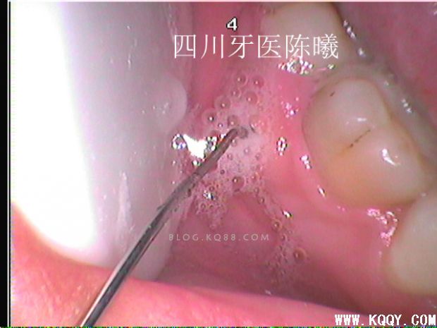标准决定技术”--一例失败根充有感！--陈希