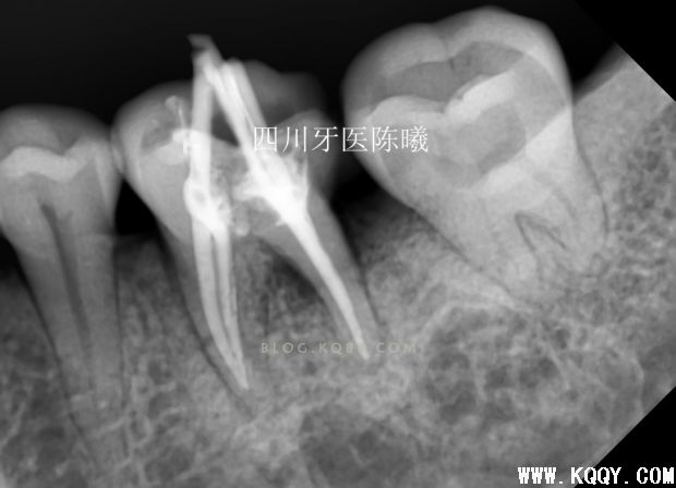 标准决定技术”--一例失败根充有感！--陈希
