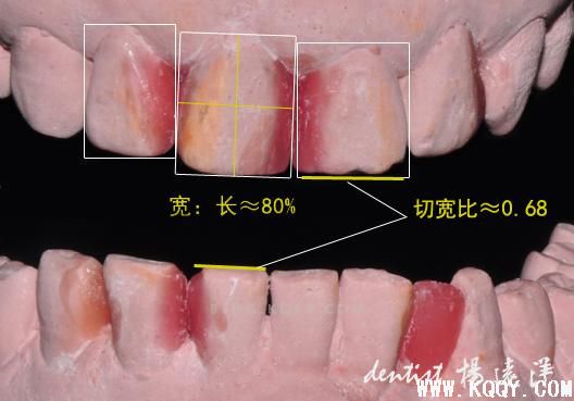 微创的诱惑——树脂与微瓷贴修复对比