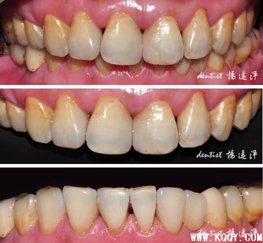 微创的诱惑——树脂与微瓷贴修复对比