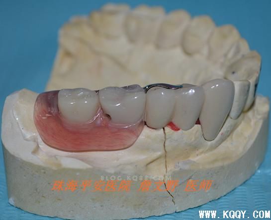MK1精密附着体义齿修复Kennedy ||类牙列缺损病例