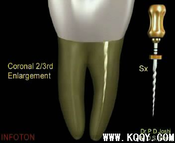 Protaper根管预备操作流程