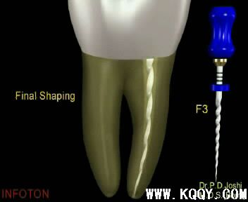 Protaper根管预备操作流程