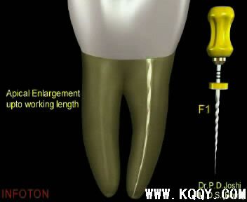 Protaper根管预备操作流程