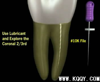 Protaper根管预备操作流程