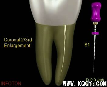 Protaper根管预备操作流程