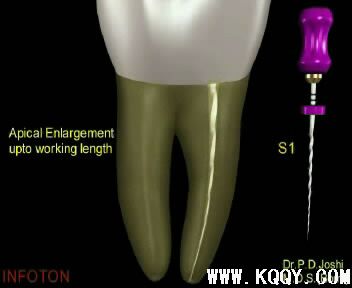 Protaper根管预备操作流程