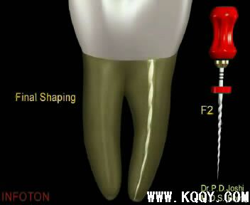 Protaper根管预备操作流程