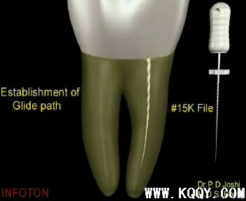 Protaper根管预备操作流程