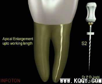 Protaper根管预备操作流程