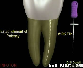 Protaper根管预备操作流程