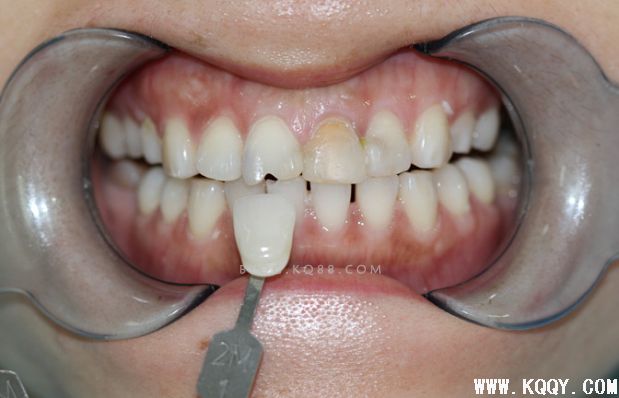 一例前牙氧化锆全瓷修复