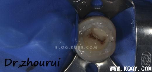 树脂分层堆塑的非技术感悟--周锐