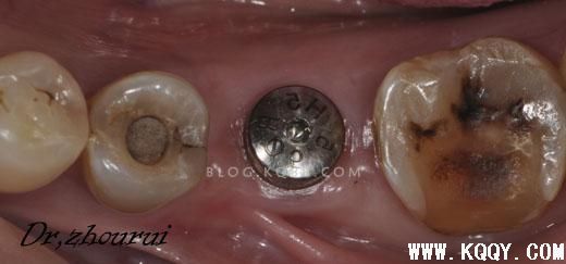 树脂分层堆塑的非技术感悟--周锐