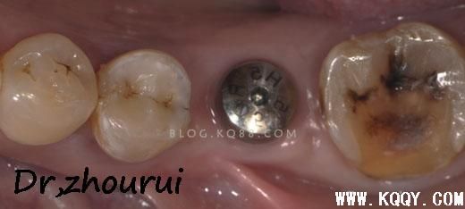 树脂分层堆塑的非技术感悟--周锐