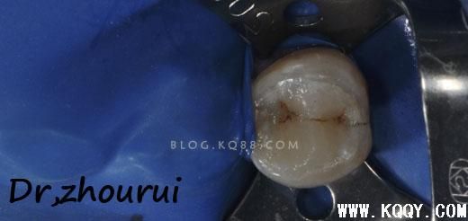 树脂分层堆塑的非技术感悟--周锐