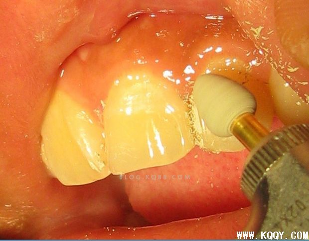 前牙树脂修形与抛光病例