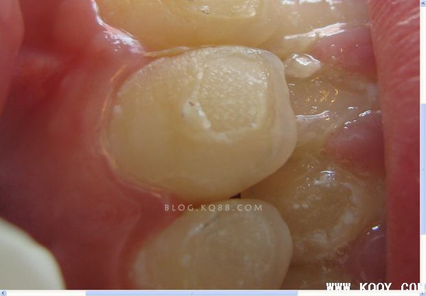 前牙树脂修形与抛光病例