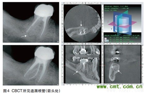 樊明文： 根管是复杂的系统