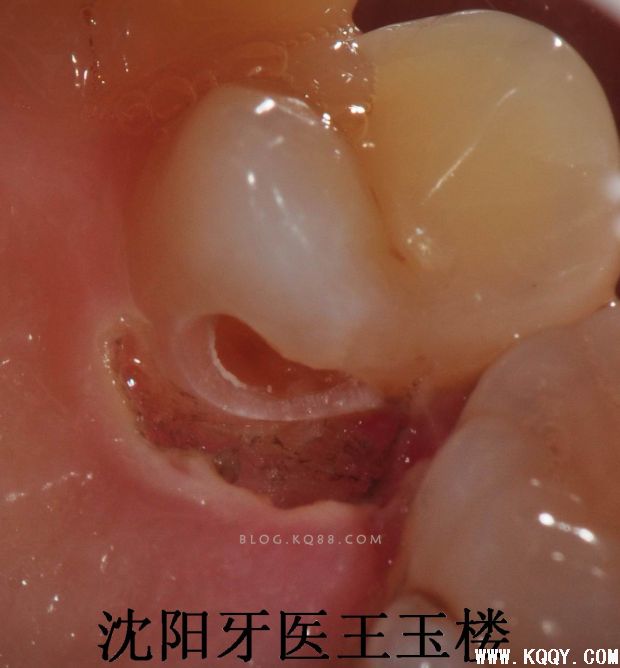 高频电刀下树脂充填