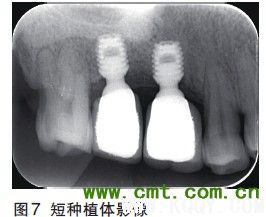 微创理念及技术 引领口腔种植步入新时代