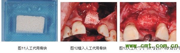 微创理念及技术 引领口腔种植步入新时代