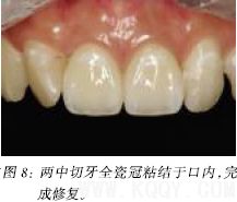 牙齿美学修复中的医技沟通和医患沟通