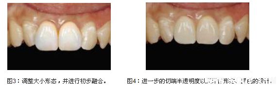 牙齿美学修复中的医技沟通和医患沟通