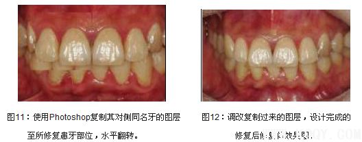 牙齿美学修复中的医技沟通和医患沟通