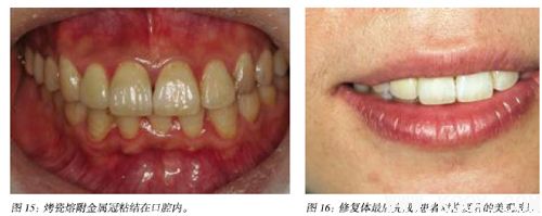 牙齿美学修复中的医技沟通和医患沟通