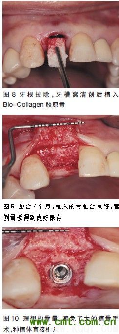 微创理念及技术 引领口腔种植步入新时代